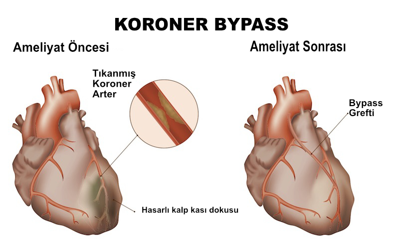 koroner-bypass