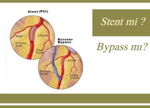stent-vs-bypass